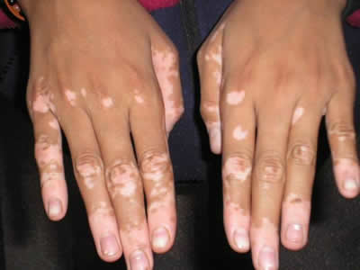 mani con vitiligine