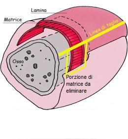 unghia incarnita trattamento chirurgico