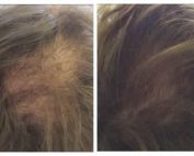 capelli prima e dopo trattamento